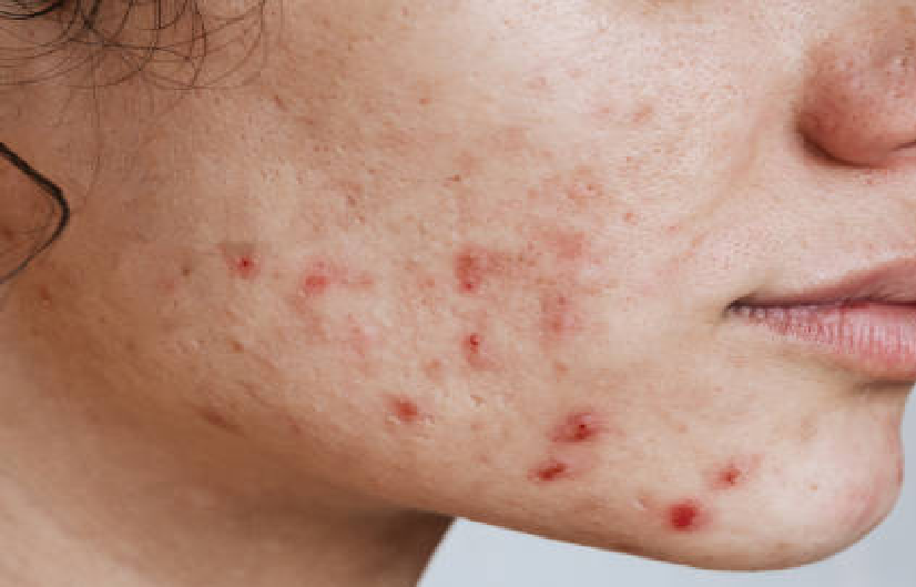 Kebiasaan Sepele Ini yang Bikin Jerawat Makin Meradang