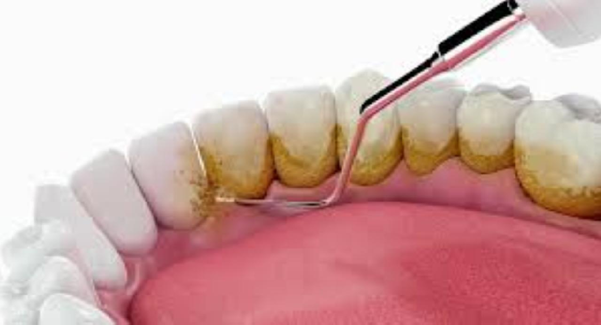 Jangan Bayar Mahal Lagi! BPJS Ternyata Menanggung Pembersihan Karang Gigi, Begini Proses Lengkapnya!