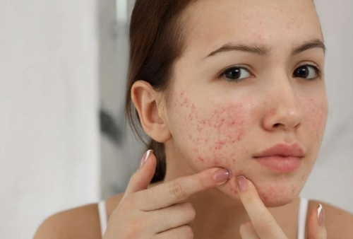 Mimuman Pagi untuk Dapat Memperbaiki Kulit Berjerawat