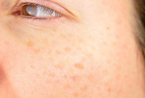 Biaya Skincare Makin Irit, Yuk Gunakan 7 Bahan Alami Ini Ampuh Hilangkan Flek Wajah