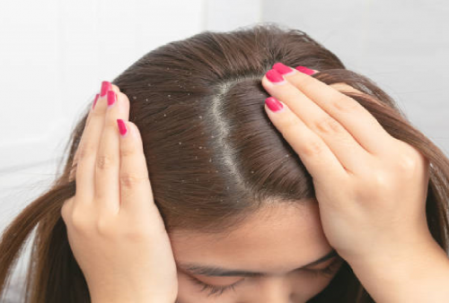 Mengapa Kulit Kepala Menjadi Kering & Mengelupas? Berikut Penjelasannya!