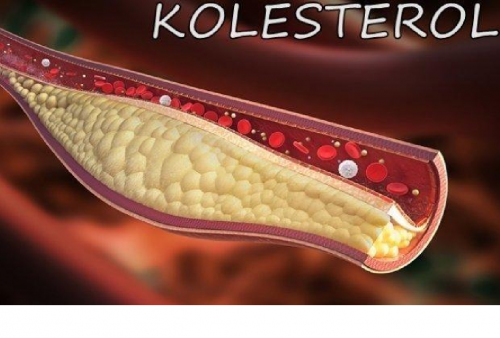 Gejala Kolesterol Tinggi Ini Sering Dianggap Sepele, Padahal Bisa Memicu Stroke dan Serangan Jantung Mendadak!