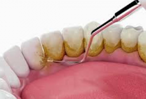 Jangan Bayar Mahal Lagi! BPJS Ternyata Menanggung Pembersihan Karang Gigi, Begini Proses Lengkapnya!